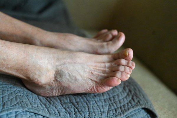 Solutions orthopédiques pour les pieds : pourquoi utiliser des hallux valgus ?
